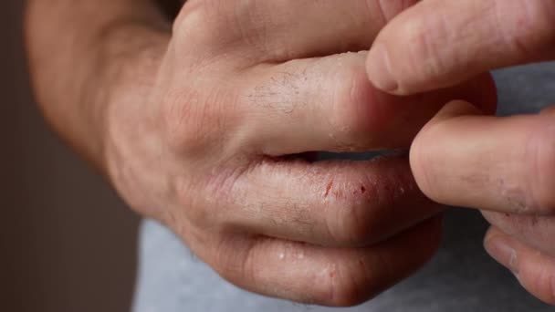 Skin Conditions - A Naturopathic Approach 1 itchy hands e1571620077779