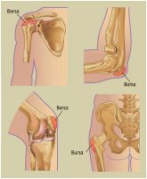 Bursitis