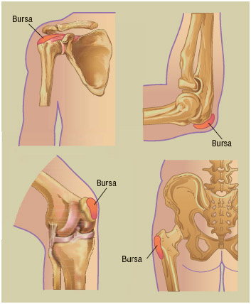 Bursitis 1 Bursitis