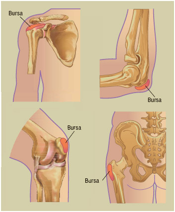 Bursitis