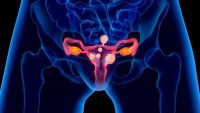 Uterine fibroids