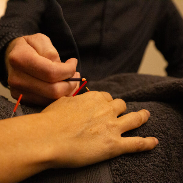 Acupuncture for hand pain
