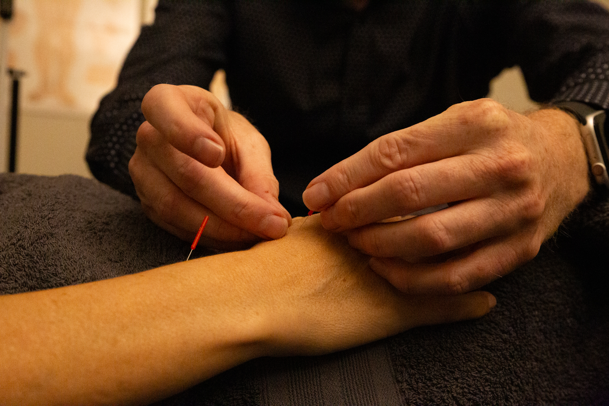 Acupuncture for Hand Pain 1 20230831 IMG 9590 2